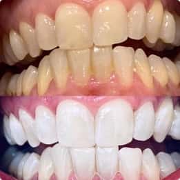 Thomas’s teeth before and after whitening treatment