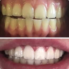 Teeth after whitening session with our Melbourne dentist