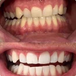 Andy’s white teeth after bleaching
