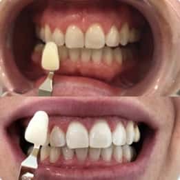 Kassandra’s teeth after treatment with our Melbourne clinic