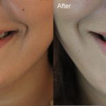 Smilebar sydney teeth whitening