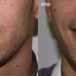 Smilebar teeth whitening treatment