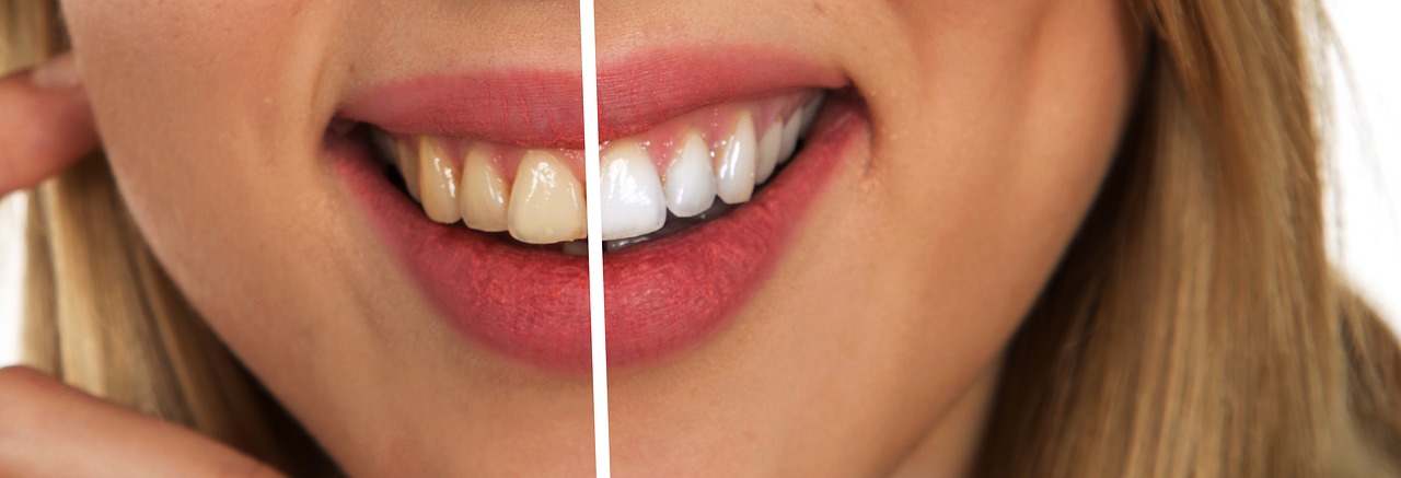 White teeth dental care