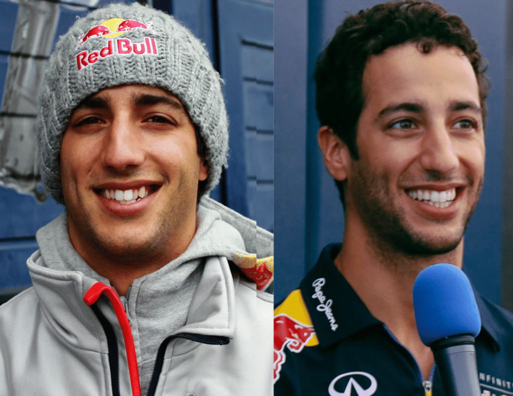 Daniel Ricciardo teeth transformation