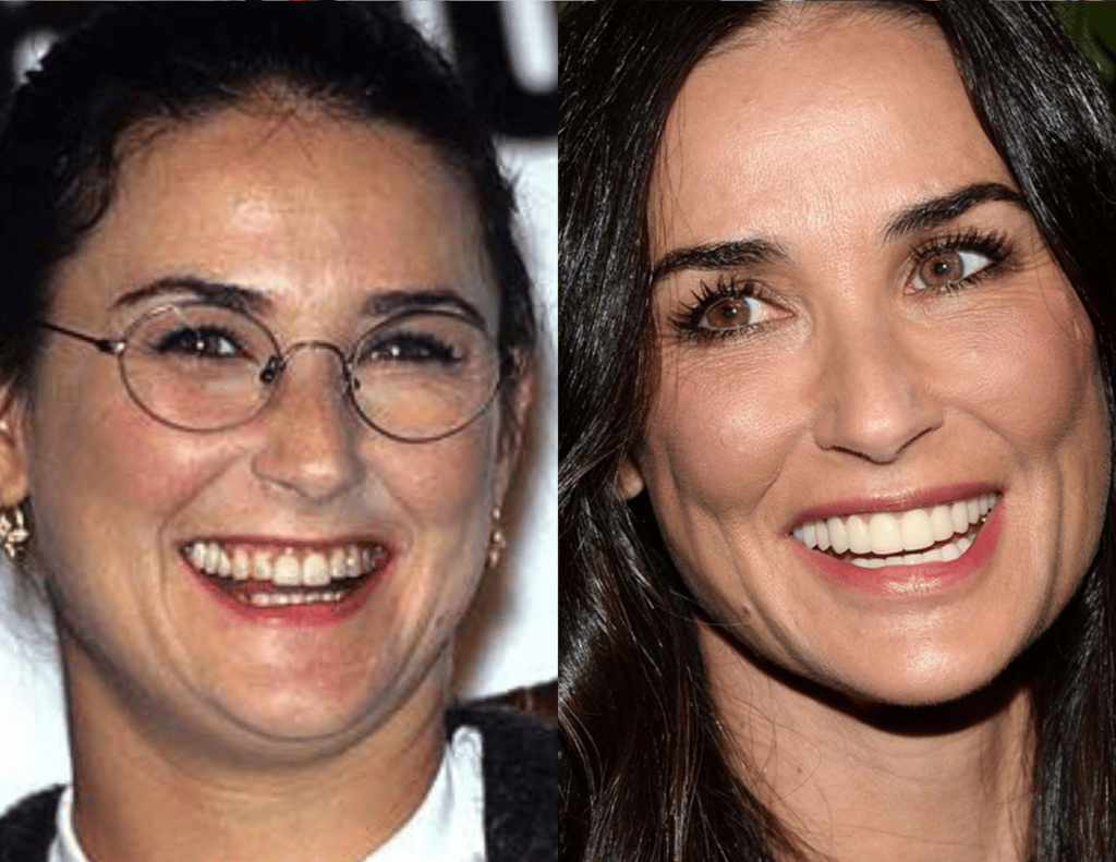 Demi Moore teeth transformation