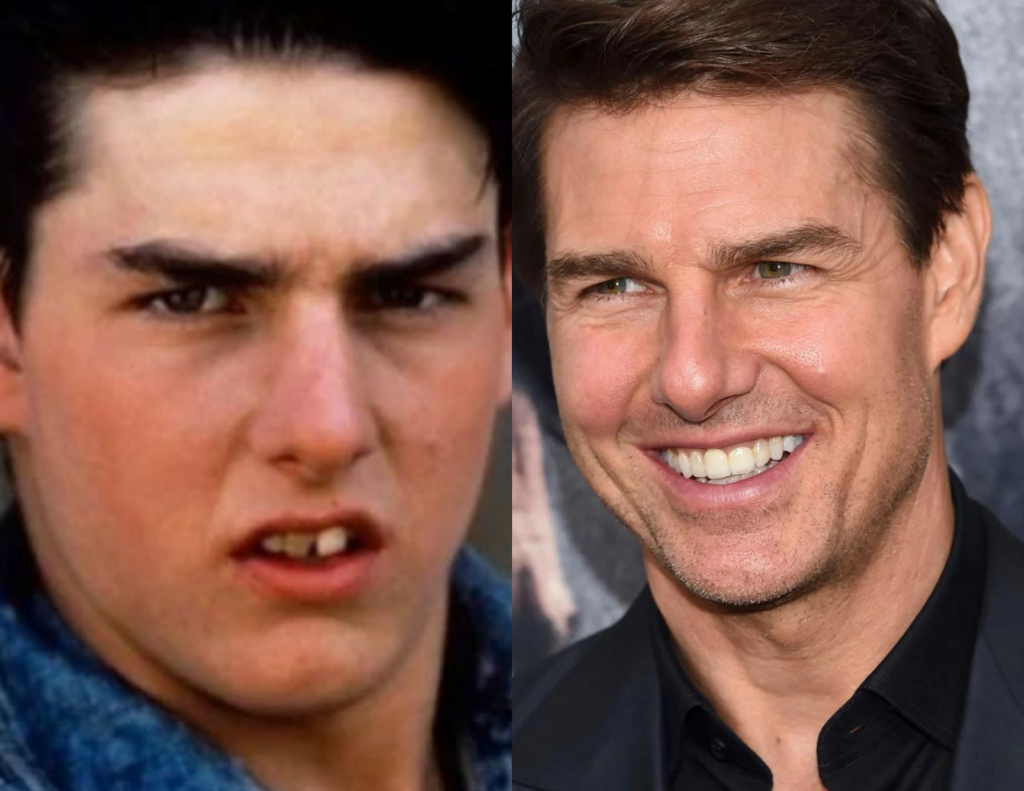 Tom Cruise didn't always have a charming smile. See his dramatic teeth transformation
