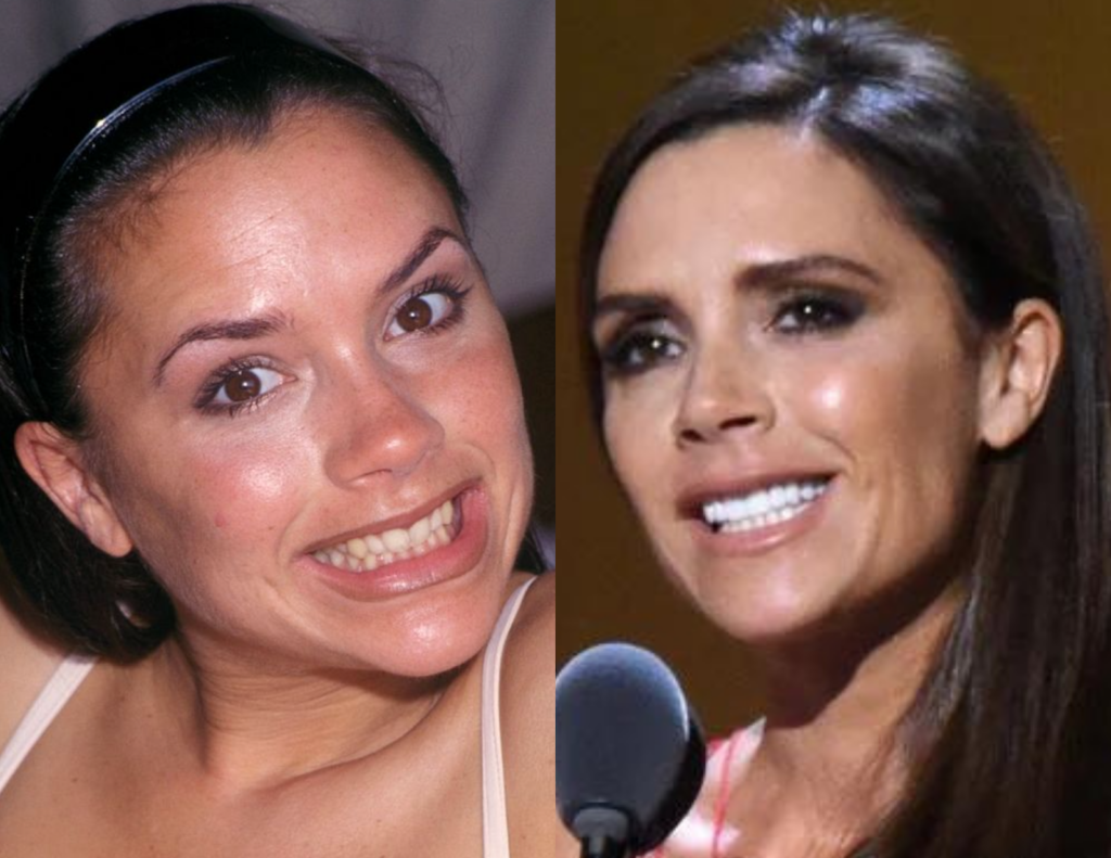 Victoria Beckham can now grin from ear to ear and show off her pearly whites