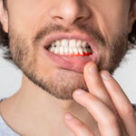 A man with burned gums.